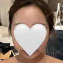 インディバ（顔） WOM SALON【術後ケア取扱いサロン】 AFTER サムネイル用