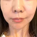 ハイフ（顔） TCB東京中央美容外科 岡山院 DAY 8 サムネイル用