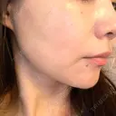 ハイフ（顔） TCB東京中央美容外科 岡山院 DAY 8 サムネイル用