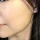 ハイフ（顔） TCB東京中央美容外科 岡山院 DAY 8 サムネイル用