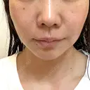 ハイフ（顔） TCB東京中央美容外科 岡山院 DAY 9 サムネイル用