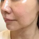 ハイフ（顔） TCB東京中央美容外科 岡山院 DAY 9 サムネイル用