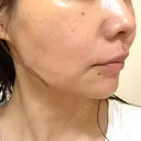 ハイフ（顔） TCB東京中央美容外科 岡山院 DAY 9 サムネイル用