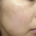 レーザートーニング（美白・肝斑） 渋谷美容外科クリニック 横浜院 AFTER サムネイル用