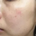 レーザートーニング（美白・肝斑） 渋谷美容外科クリニック 横浜院 DAY 20 サムネイル用