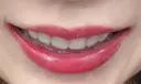 ガミースマイル手術 / その他（審美歯科/矯正歯科） / 矯正（ワイヤー） / セラミック 東京銀座A CLINIC デンタル DAY 253 サムネイル用