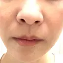 イオン導入 / ピコレーザートーニング（美白・肝斑） 湘南美容クリニック 静岡院 DAY 0 サムネイル用