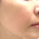 イオン導入 / ピコレーザートーニング（美白・肝斑） 湘南美容クリニック 静岡院 DAY 0 サムネイル用