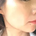 ハイフ（顔） TCB東京中央美容外科 岡山院 DAY 13 サムネイル用