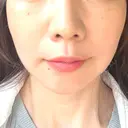 ハイフ（顔） TCB東京中央美容外科 岡山院 AFTER サムネイル用