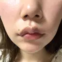 口角挙上 宇都宮竹内クリニック DAY 3 サムネイル用