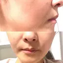 イオン導入 / ピコレーザートーニング（美白・肝斑） 湘南美容クリニック 静岡院 DAY 1 サムネイル用