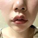 口角挙上 宇都宮竹内クリニック DAY 4 サムネイル用