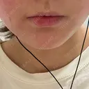 ボトックス（エラ・小顔） LOUIS CLINIC 二子玉川院【ルイクリニック】 DAY 6 サムネイル用