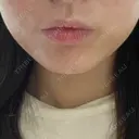 ボトックス（エラ・小顔） LOUIS CLINIC 二子玉川院【ルイクリニック】 AFTER サムネイル用