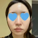 ピーリング（ニキビ・毛穴） / ピコフラクショナルレーザー（毛穴・ニキビ跡） CLINICA BellaForma AFTER サムネイル用