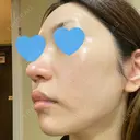 ピーリング（ニキビ・毛穴） / ピコフラクショナルレーザー（毛穴・ニキビ跡） CLINICA BellaForma DAY 11 サムネイル用