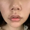 口角挙上 宇都宮竹内クリニック DAY 6 サムネイル用