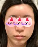 糸リフト / 額を丸く / こめかみ形成 / 脂肪注入（額） eクリニック 金沢本院 DAY 0 サムネイル用