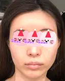 糸リフト / 額を丸く / こめかみ形成 / 脂肪注入（額） eクリニック 金沢本院 AFTER サムネイル用