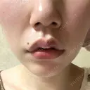 口角挙上 宇都宮竹内クリニック DAY 8 サムネイル用