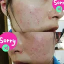 イオン導入 / ほくろ・いぼ除去レーザー（肌） / フラクショナルレーザー（毛穴・ニキビ跡） あおい皮フ科クリニック DAY 84 サムネイル用