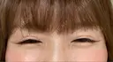 ボトックス（目尻） TCB東京中央美容外科 大宮東口院 AFTER サムネイル用
