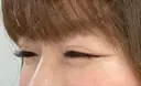 ボトックス（目尻） TCB東京中央美容外科 大宮東口院 DAY 20 サムネイル用