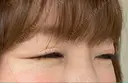 ボトックス（目尻） TCB東京中央美容外科 大宮東口院 DAY 20 サムネイル用