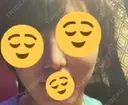 ヒアルロン酸注入（鼻） 青山外苑前クリニック DAY 6 サムネイル用