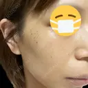 毛穴洗浄（ハイドラフェイシャルなど） / 光治療（フォトフェイシャルなど） まゆりなclinic 名古屋栄 DAY 4 サムネイル用