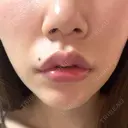 口角挙上 宇都宮竹内クリニック DAY 12 サムネイル用