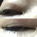 二重埋没 Olino美容外科・美容皮膚科 AFTER サムネイル用