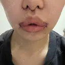 小鼻縮小（切開） / 人中短縮 / 鼻翼挙上 / 口角挙上 Otus Clinic 【オータスクリニック】 DAY 2 サムネイル用