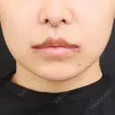 小鼻縮小（切開） / 人中短縮 / 鼻翼挙上 / 口角挙上 Otus Clinic 【オータスクリニック】 DAY 8 サムネイル用