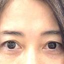 クマ治療 / 下まぶたの脂肪取り / ヒアルロン酸注入（目の下） ネビュラクリニック 広島院 AFTER サムネイル用