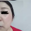 エレクトロポレーション / 光治療（フォトフェイシャルなど） S.T styleクリニック AFTER サムネイル用