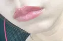 ヒアルロン酸注入（唇） / ボトックス（口角） ルラ美容クリニック 広島院 DAY 0 サムネイル用
