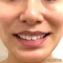 口角挙上 ヴェリテクリニック 名古屋院 DAY 255 サムネイル用