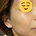 毛穴洗浄（ハイドラフェイシャルなど） / 光治療（フォトフェイシャルなど） まゆりなclinic 名古屋栄 AFTER サムネイル用
