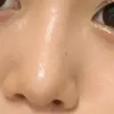 隆鼻術 / 鼻尖形成（切開） / 軟骨移植 / 鼻尖縮小 もとび美容外科クリニック 新宿院 DAY 74 サムネイル用