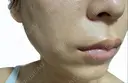 ヒアルロン酸注入（唇） / ボトックス（口角） ルラ美容クリニック 広島院 DAY 1 サムネイル用