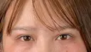 二重切開 / 目頭切開 藤・ナチュレ美容クリニック 恵比寿院 AFTER サムネイル用