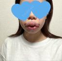 脂肪吸引（顔） / 口唇縮小術 / 口角挙上 / ジョールファット除去 / ヒアルロン酸注入（あご） / ボトックス（エラ・小顔） / ボトックス（口角） Otus Clinic 【オータスクリニック】 DAY 3 サムネイル用