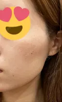 ピーリング（ニキビ・毛穴） / イオン導入 渋谷美容外科クリニック 新橋院 DAY 2 サムネイル用