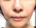 ピコレーザートーニング（美白・肝斑） TCB東京中央美容外科 銀座有楽町院 DAY 3 サムネイル用