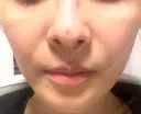 ピコレーザートーニング（美白・肝斑） TCB東京中央美容外科 銀座有楽町院 DAY 4 サムネイル用