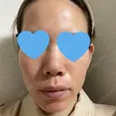 ヴェルヴェットスキン KOBE美容皮膚科 神戸東灘院 DAY 2 サムネイル用
