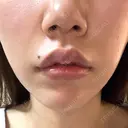 口角挙上 宇都宮竹内クリニック DAY 22 サムネイル用