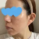 ヴェルヴェットスキン KOBE美容皮膚科 神戸東灘院 DAY 3 サムネイル用